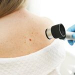 Skin Cancer Prevention