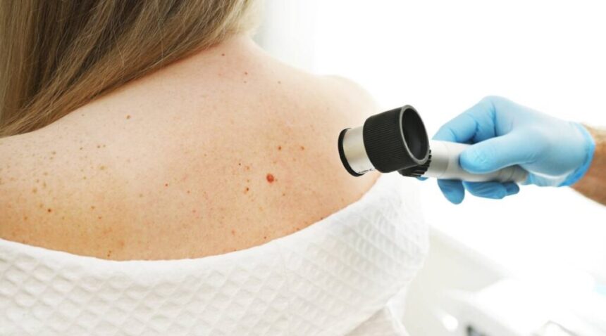 Skin Cancer Prevention